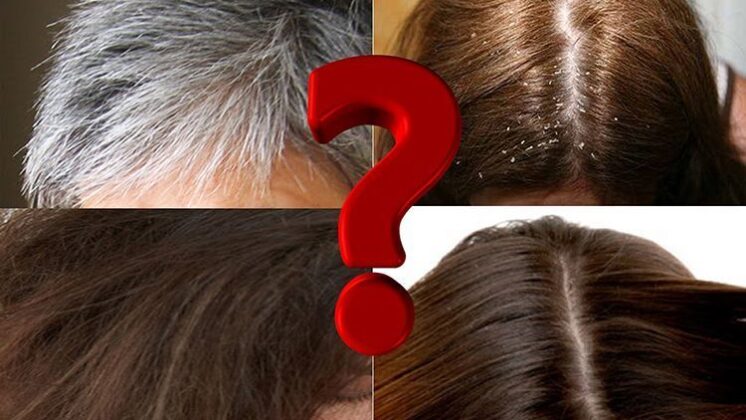 www.volviendoanacer.es | Terapia PsicoBioEmocional Madrid y Skype - Bioneuroemoción - Hipnosis | Caspa - Canas - Sequedad - Grasa... Conflictos biológicos del Cabello (Parte 1)