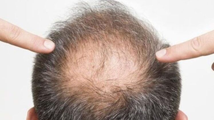 www.volviendoanacer.es | Psicobiorenacer Emocional | © Descodificación Biológica Integrativa (DBI) | Caída, Calvicie y Alopecia - Conflictos biológicos del Cabello (Parte 2)