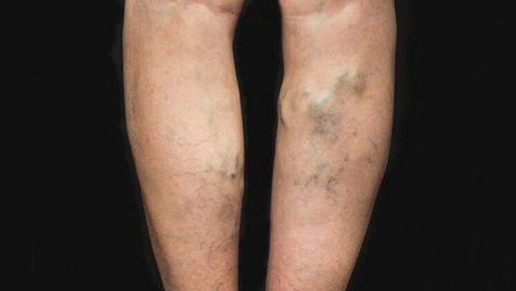 www.volviendoanacer.es | Terapia PsicoBioEmocional Madrid y Skype - Bioneuroemoción - Hipnosis | Varices: Conflictos biológicos