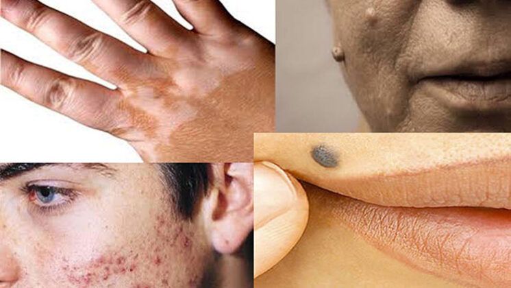 www.volviendoanacer.es | Psicobiorenacer Emocional | © Descodificación Biológica Integrativa (DBI) | Verruga - Lunar - Melanoma - Vitíligo - Acné-... Conflictos biológicos de la Piel (Parte 2)