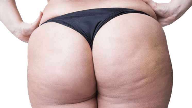 www.volviendoanacer.es | Psicobiorenacer Emocional | © Descodificación Biológica Integrativa (DBI) | Celulitis - Lipoma - Lupus... Conflictos biológicos de la Piel (Parte 3)