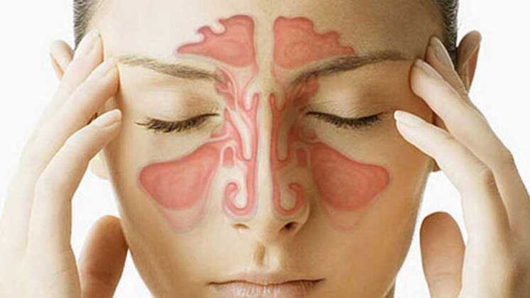 www.volviendoanacer.es | Psicobiorenacer Emocional | © Descodificación Biológica Integrativa (DBI) | Rinitis Alérgica - Vasomotora - Atrófica - del Embarazo... Conflictos biológicos