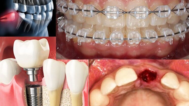 https://volviendoanacer.es | © Descodificación Biológica Integrativa (DBI) | Empaste - Endodoncia - Extracción... Conflictos Biológicos de la Boca (Parte 5)