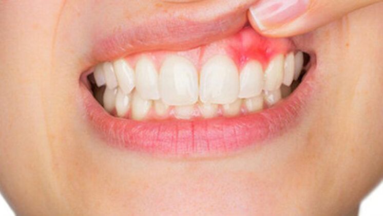 www.volviendoanacer.es | Psicobiorenacer Emocional | © Descodificación Biológica Integrativa (DBI) | Conflictos Biológicos de la Boca: Gingivitis, bruxismo, afta... (Parte 3) | "Atrapar el bocado", instinto de supervivencia