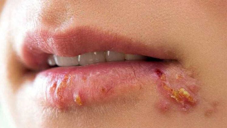 www.volviendoanacer.es | Psicobiorenacer Emocional | © Descodificación Biológica Integrativa (DBI) | Herpes Simplex y Zóster: Conflictos biológicos y resentir emocional