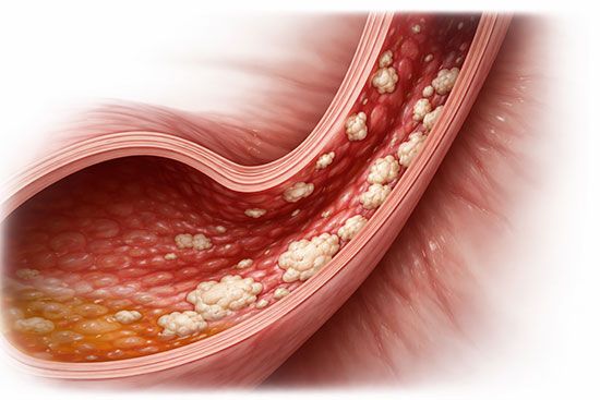 www.volviendoanacer.es | Candidiasis y su significado biológico según la Descodificación Biológica Integrativa